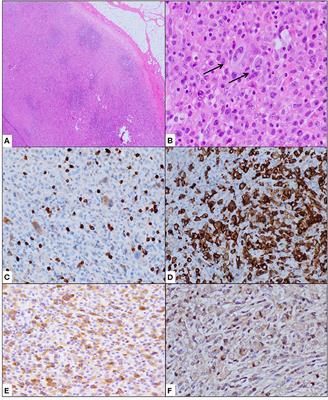 Diagnostic Capability of Next-Generation Sequencing Fusion Analysis in Identifying a Rare CASE of TRAF1-ALK-Associated Anaplastic Large Cell Lymphoma